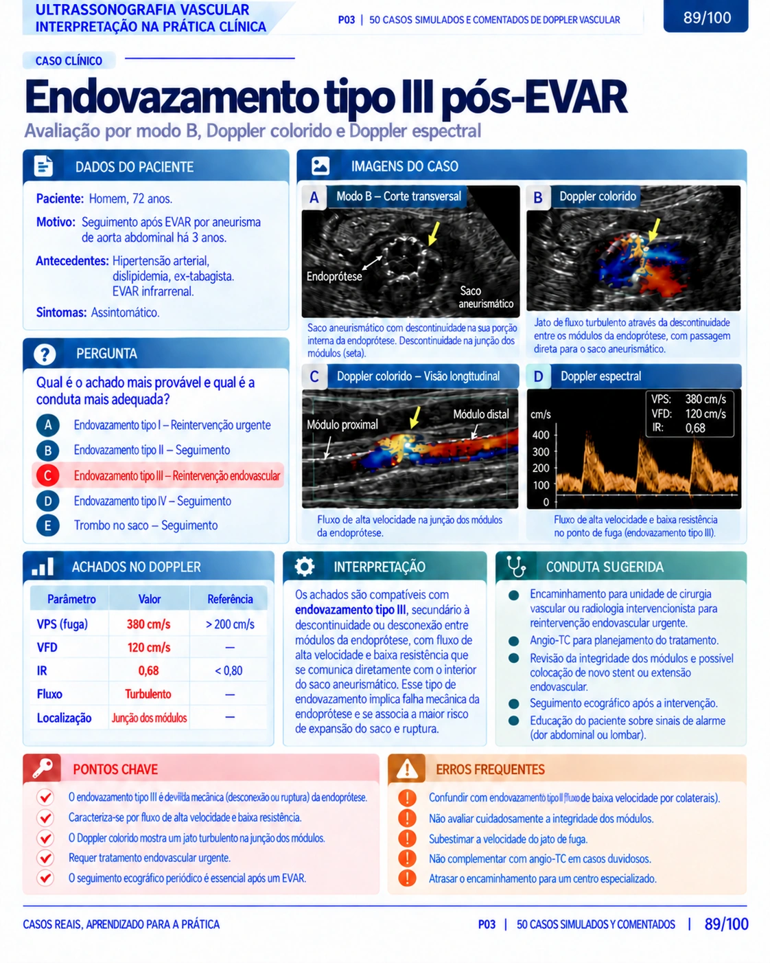 Página 89: Caso: endovazamento tipo III pós-EVAR. Amostra do material digital de Doppler vascular.
